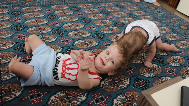 Conjoined Turkish twins celebrate first birthday