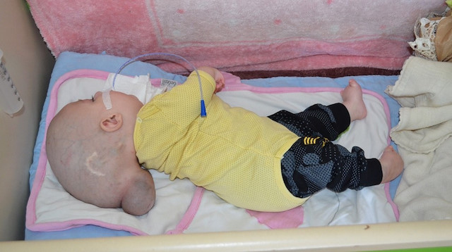 2 aylık Yunus Emre isimli bebeğin beyninin bir kısmı, kafatasının dışında büyüyor.