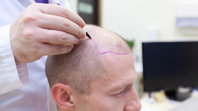 Saç ekiminde hastane dışında yapılan başarısız uygulamalar tehdit oluşturuyor.