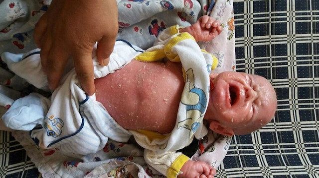 Arşiv / Balık pulu hastalığı olan bir bebek