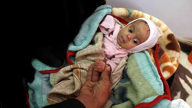 File photo: Famine in Yemen

