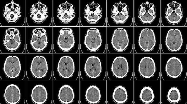 Araştırmanın sonuçları, "Cerebral Cortex" dergisinde yayımlandı. 

