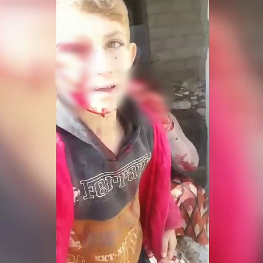 Esedin bombardımanında yaralanan çocuklar izleyenlerin yüreklerini sızlattı