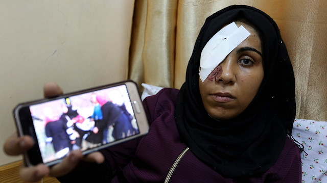 شابة من غزة تفقد عينها برصاصة إسرائيلية