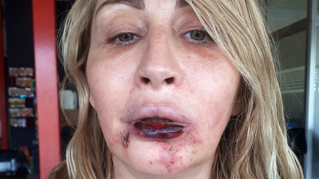 Antalya'da aşçılık yapan 3 çocuk annesi Songül Uzunoğlu, gözaltı torbalarından kurtulmak için arkadaşlarının tavsiyesi üzerine geçen Şubat ayında Muratpaşa ilçesi Lara turizm bölgesindeki güzellik ve estetik merkezine gitti. Uzunoğlu'na, göbek bölgesinden alınan yağın, yüz bölgesinin dolgusunda kullanılacağı, operasyonun çok kalıcı, ekonomik ve 2 yıl garantili olduğu söylendi. Estetik merkezindeki yetkililerle görüşen ve Mart ayı başında ameliyatının yapılmasını isteyen Uzunoğlu, operasyon için 5 bin 500 lirayı nakit ödedi.