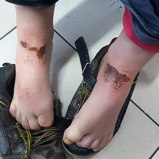 Kar topu sonrası vücudunda yanıklar oluşan 9 çocukla ilgili rapor bekleniyor