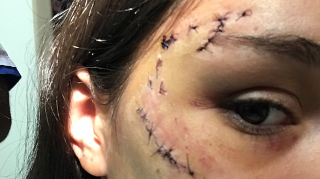  Hastaneye kaldırılan kızın yüzüne 40 dikiş atıldı.