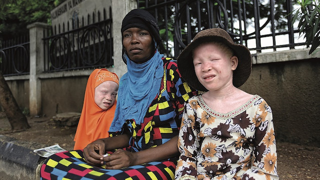 Afrikalı albinolar.