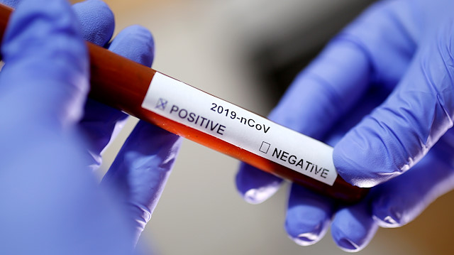 Koronavirüs testinde pozitif çıkan bir kan tüpü örneği.