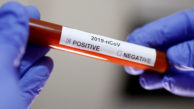 Koronavirüsün pozitif çıktığı kan tüpü örneği.