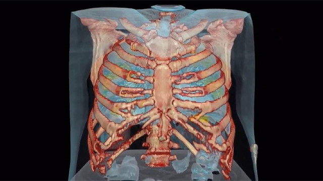 3D akciğer simülasyonunda, sağlıklı akciğer dokularının yarı saydam mavi renklerde, sağlıksız olanların ise yeşil renkli iltihaplı doku şeklinde olduğu görünüyor.