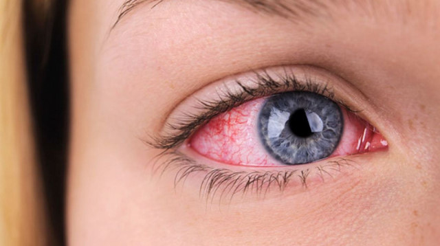 Her kırmızı göz, koronavirüs belirtisi demek değil