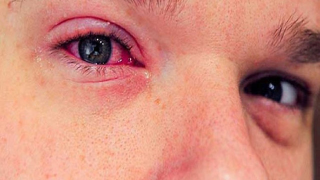 Gözlerdeki konjonktiva kırmızılık, en az görülen koronavirüs semptomu.