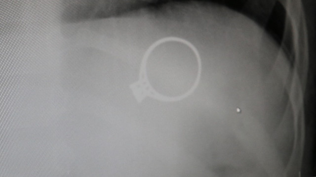 Çekilen röntgende, 1.5 yaşındaki bebeğin annesinin yüzüğünü yuttuğu belirlendi.