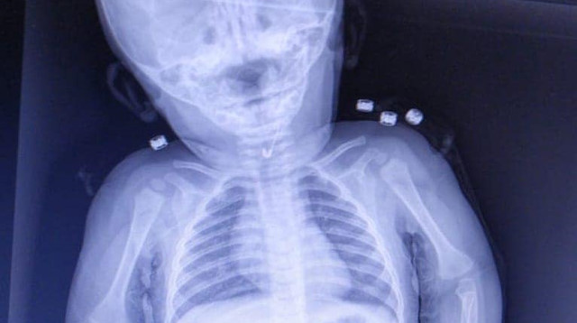 Çekilen röntgende, bebeğin çengelli iğne yuttuğu tespit edildi.

