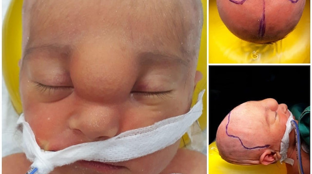 ‘Buğlem’ adı verilen bebek Beyin ve Sinir Cerrahisi Uzmanı Dr. İsmail Demir liderliğinde gerekli tetkiklerinin yapılmasının ardından hemen ameliyata alındı.