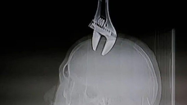 Çinli adamın kafasına saplanan kurbağacık röntgen filminde böyle görüntülendi. 