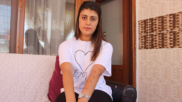 Diyarbakırlı genç kız güzellik merkezinde kâbusu yaşadı: Her yeri yandı