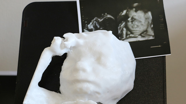 Ultrason cihazı aracılığıyla elde edilen bebeğin görüntüsü.