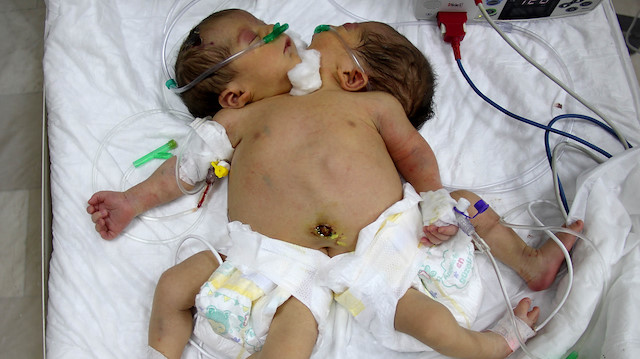 Minik ikizlerin tedavisi Türkiye'de devam ediyor.