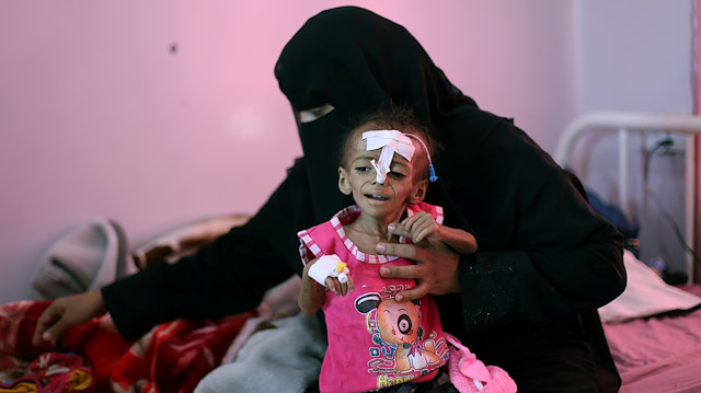 A woman holds her malnourished daughter at a malnutrition treatment ward of al-Sabeen hospital in Sanaa, Yemen October 27, 2020.
