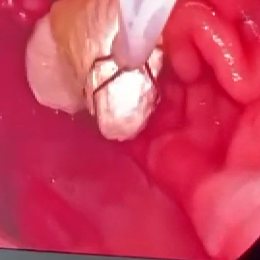 Uyuşturucu şüphelisinin yuttuğu eroin, endoskopi ile çıkarıldı