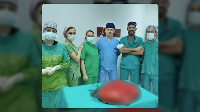Trabzon’da ameliyata alınan hastanın karnından 21 kiloluk tümör çıkartıldı.
