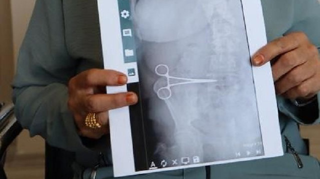 Hastanın röntgenini inceleyen doktorlar makası tespit etti.