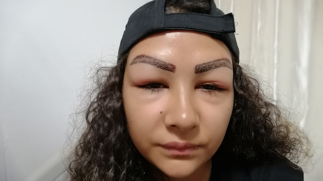 Bir estetik faciası daha: Reklam yüzü olmak için gitti hastanelik oldu