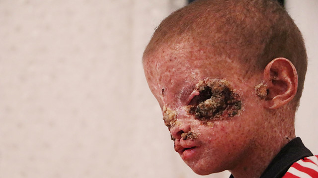 Yüzünü saran yaralar iyileşiyor: Salih'ten sevindirici haber