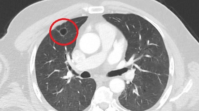 Hastanin çekilen tomografisinde sağ akciğerinde 4 santimetre çapında tümör tespit edildi.