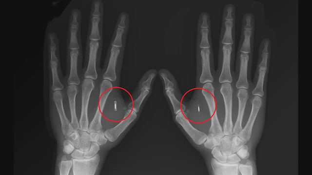 Tolga Özuygur cerrahi operasyonla ellerine NFC çipi yerleştirdi. 