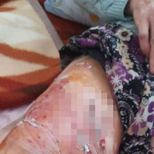 Antalyada Pitbullların saldırdığı kadın yaralandı: Gitti geldi yine ısırdı