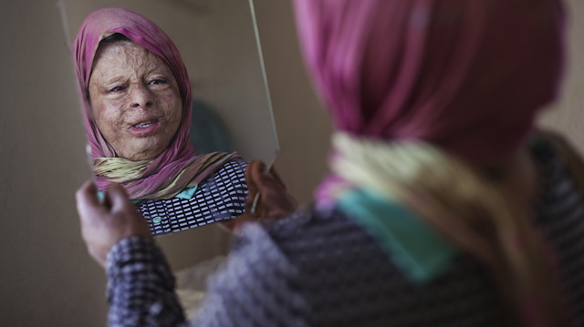 Yedi yılda 40 ameliyat oldu: Vücudunda savaşın izleri var