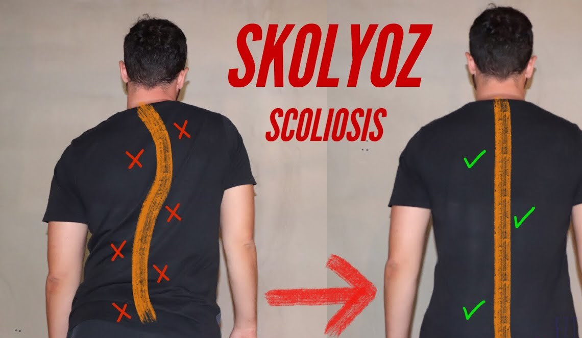 Skolyoz nasıl olur ve nasıl tedavi edilir?