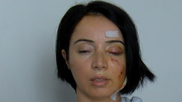 Samsun'da restoran çıkışı köpek saldırısına uğrayan anne ve kızı yaralandı