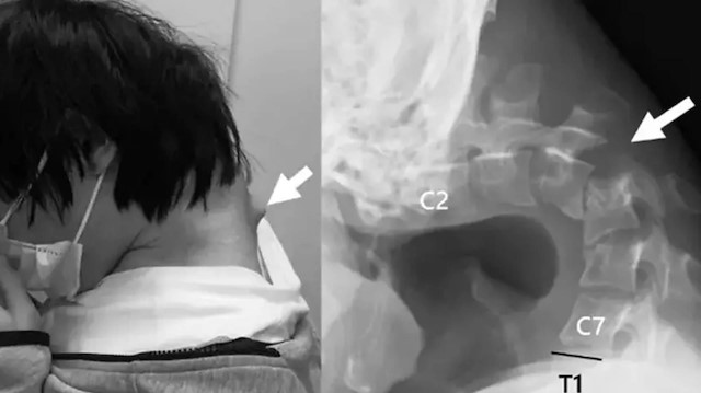 Telefona bakmaktan boynu yamuldu: Akılalmaz hastalıkla tıp literatürüne girdi