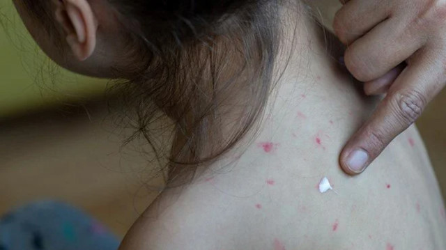 Ölümcül hastalıkta vaka sayısı artıyor: Aşı olmadan tatile çıkmayın