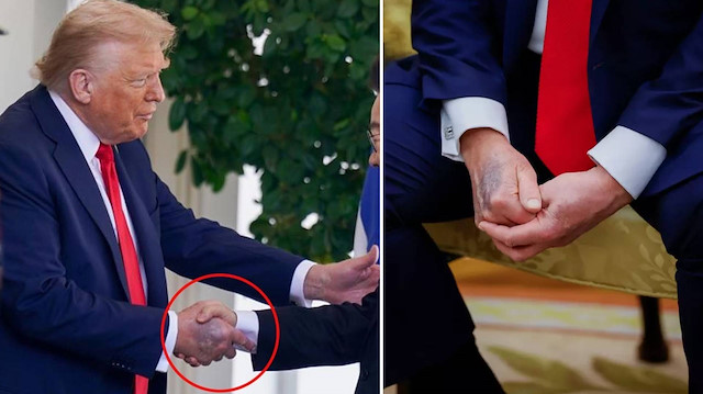 Trump’ın elindeki morluk ne anlama geliyor? Beyaz Saray’dan açıklama