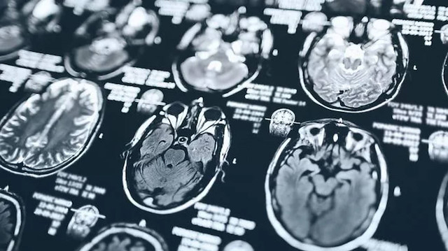 Eşitsizliğin çocuk beynindeki etkisi: Çalışma önemli bulgular sundu