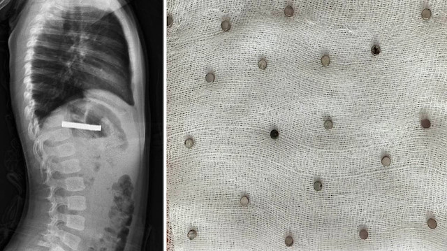 3 yaşındaki çocuğun boğazından çıkanlar hayrete düşürdü,: Tam 19 tane!