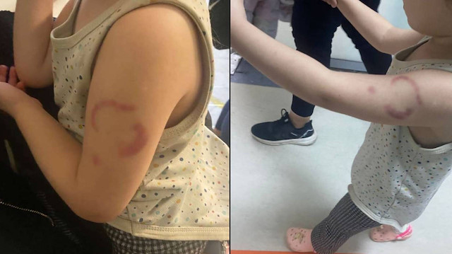 Kreşte skandal olay! Öğretmen, 3 yaşındaki çocuğu ısırmıştı: Tutuklandı