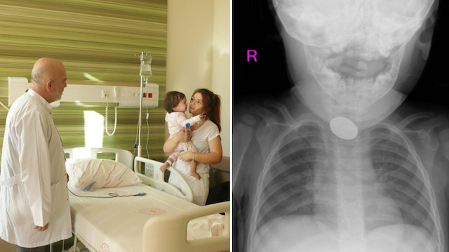 Nefes kesen operasyon: Pil ve lego parçası yutan bebek ameliyatla hayata döndü