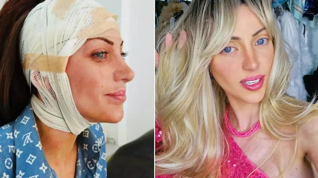 Barbie'ye benzemek için 27 kez ameliyat olmuştu: 31 yaşında hayatını kaybetti