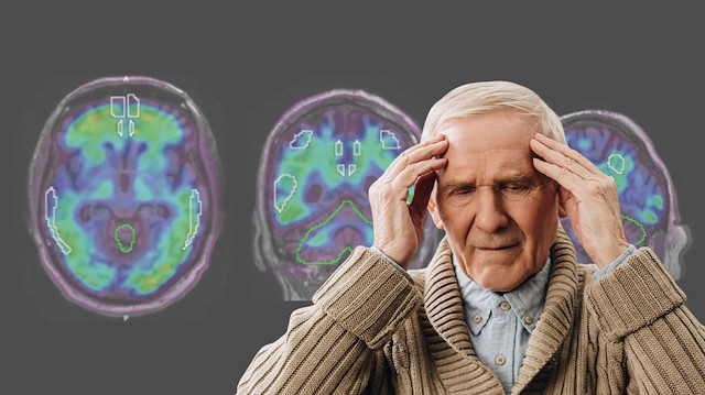 Yeni araştırma ortaya koydu: Alzheimer hastalarında sosyal hafızayı korumak mümkün mü?