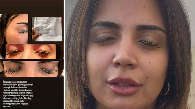 Güzellik salonunda kirpik uygulaması skandalı: Kimyasal madde retinaya kadar girdi! 'Kör olabilirdim'