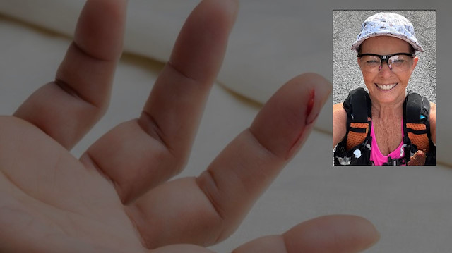 Sosyal medya bunu konuşuyor! Basit bir kesik kabusa dönüştü