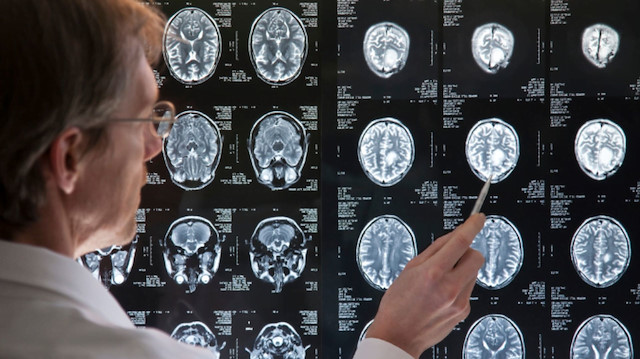 Beyin kanseri için beklenmedik çözüm: Tansiyon ilacının etkisi ortaya çıktı