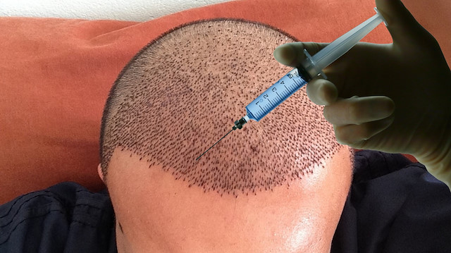 Sahte saç ekim uzmanı ortaya çıktı! Ünlü futbolcuya bile işlem yapmış