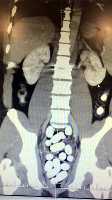 Three drug couriers caught with stomachs full of 'cocaine' at Istanbul Airport